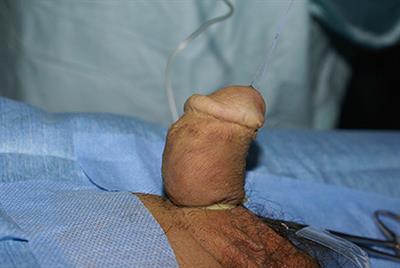 Commentary: Results of Onlay Preputial Flap Urethroplasty for the Single-Stage Repair of Mid-and Proximal Hypospadias